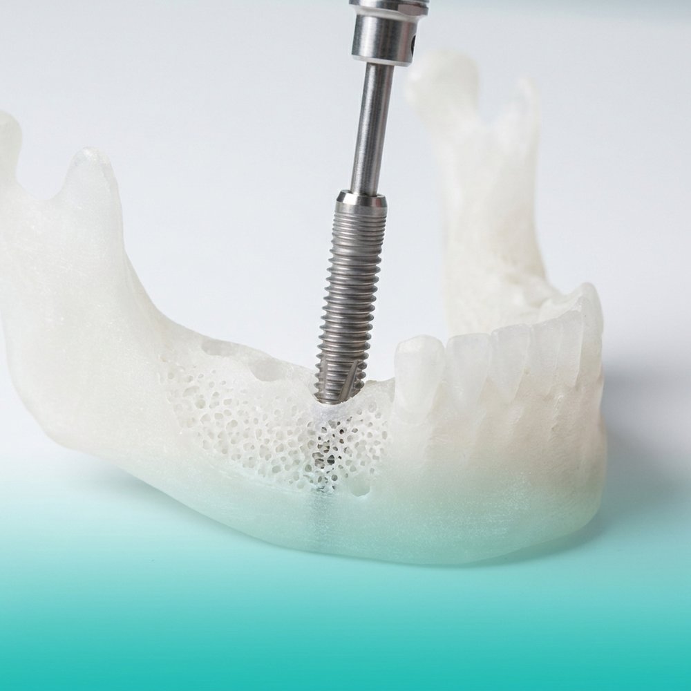 Tratamento de implante na Oral Unic Alvorada