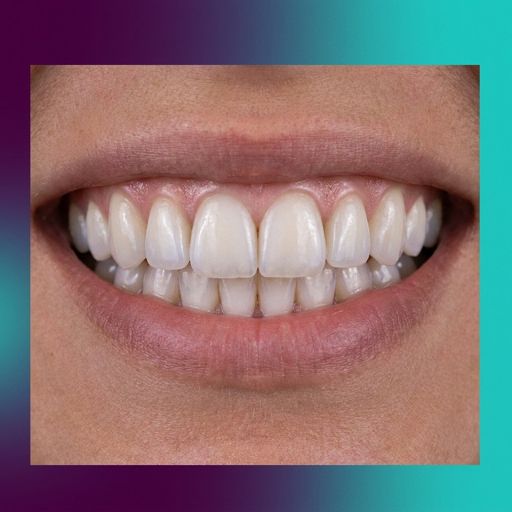 Lentes de contato dental em porcelana