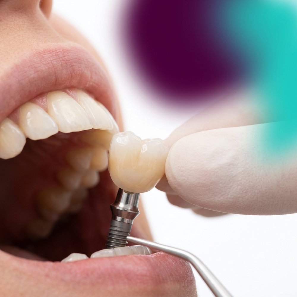 Coroa protética sendo instalada sobre implante dentário